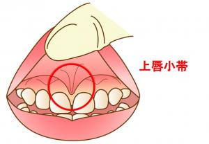 上唇小帯は上の前歯の外側にあるすじです。