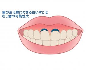 前歯と歯茎の境目にできた虫歯のイラスト